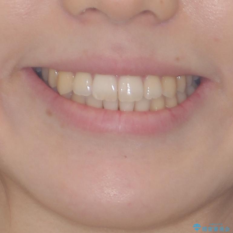 気になる前歯を整えたい インビザライン・ライトでの矯正治療の治療後(顔貌)