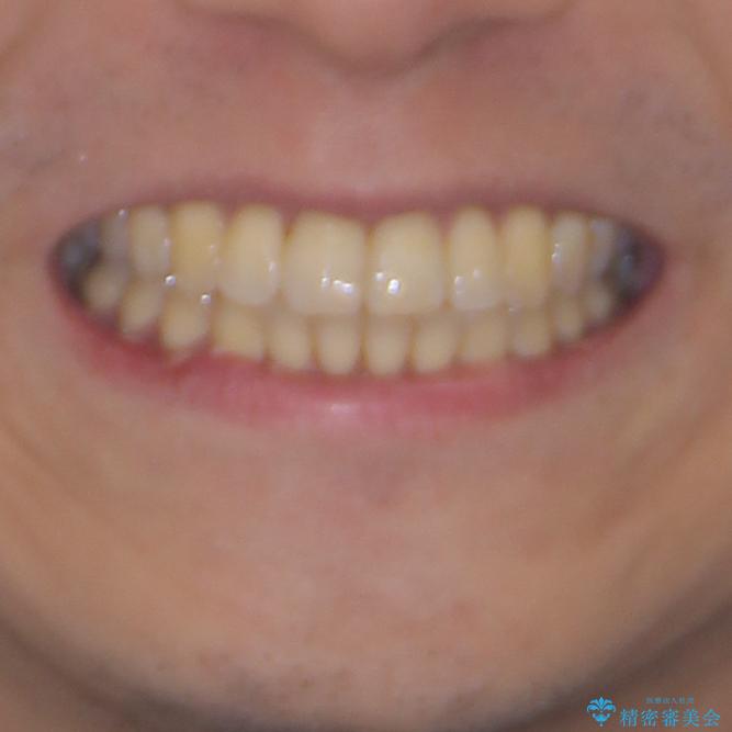 前歯のデコボコ　ワイヤー装置での短期間治療の治療後（顔貌）