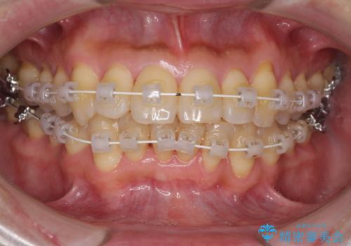 前歯のデコボコ　ワイヤー装置での短期間治療の治療中