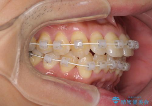 前歯のデコボコ ワイヤー装置での短期間治療の治療中