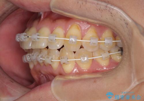 前歯のデコボコ　ワイヤー装置での短期間治療の治療中