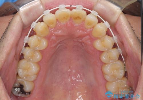 前歯のデコボコ ワイヤー装置での短期間治療の治療中