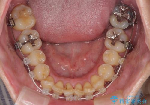 前歯のデコボコ ワイヤー装置での短期間治療の治療中