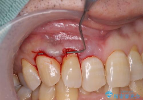 歯根が露出している歯の歯肉移植 根面被覆術の治療前