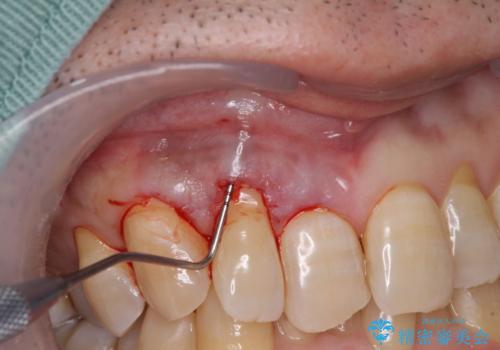 歯根が露出している歯の歯肉移植　根面被覆術の治療中