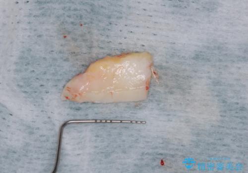 歯根が露出している歯の歯肉移植 根面被覆術の治療前