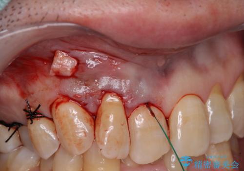 歯根が露出している歯の歯肉移植　根面被覆術の治療後