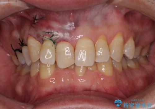 歯根が露出している歯の歯肉移植 根面被覆術の治療中