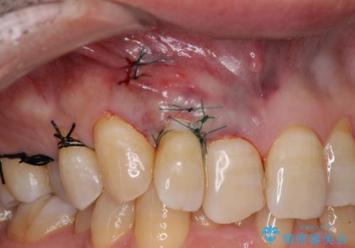 歯根が露出している歯の歯肉移植　根面被覆術の治療中