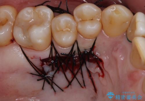 歯根が露出している歯の歯肉移植 根面被覆術の治療中