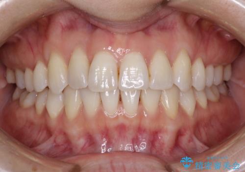 インビザラインによる矯正治療　前歯を整った歯並びへの症例 治療後