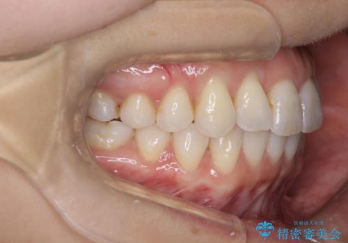 インビザラインによる矯正治療　前歯を整った歯並びへの治療後
