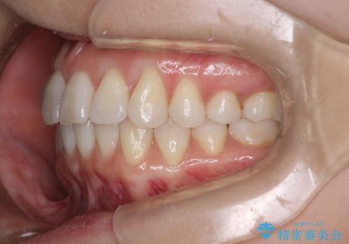 インビザラインによる矯正治療 前歯を整った歯並びへの治療後