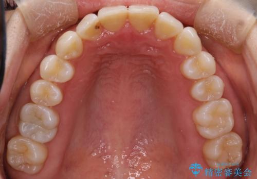 インビザラインによる矯正治療 前歯を整った歯並びへの治療後