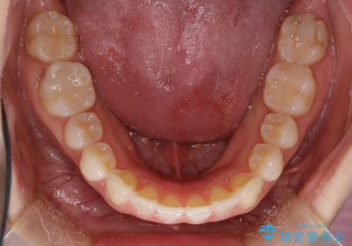 インビザラインによる矯正治療　前歯を整った歯並びへの治療後