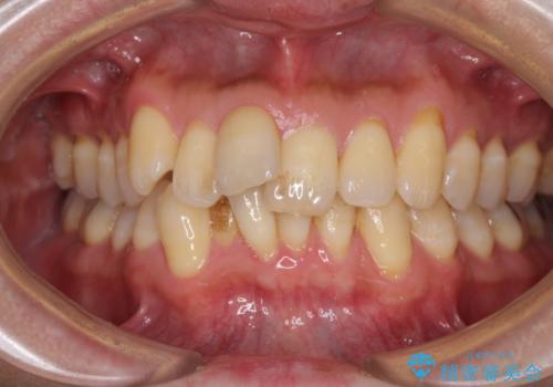 前歯のデコボコ ワイヤー装置での短期間治療の治療前