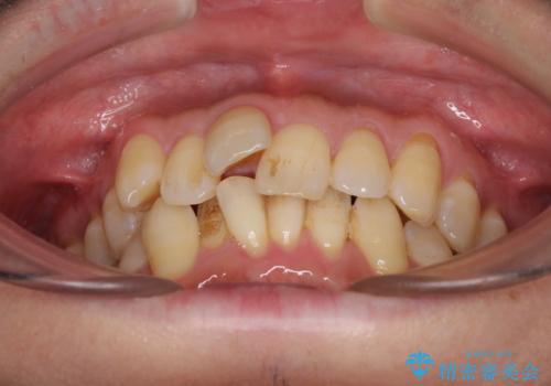 前歯のデコボコ ワイヤー装置での短期間治療の治療前