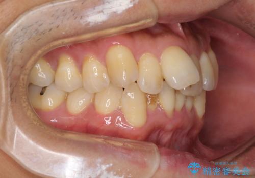 前歯のデコボコ　ワイヤー装置での短期間治療の治療前