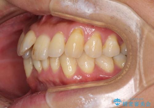 前歯のデコボコ　ワイヤー装置での短期間治療の治療前