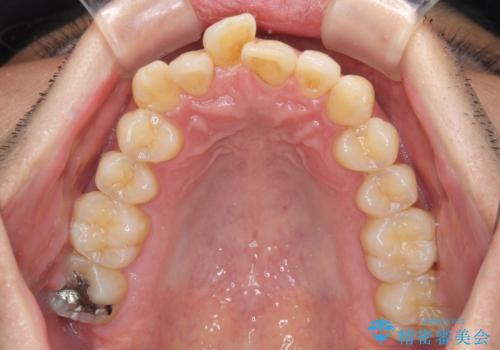 前歯のデコボコ ワイヤー装置での短期間治療の治療前