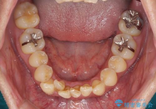 前歯のデコボコ ワイヤー装置での短期間治療の治療前