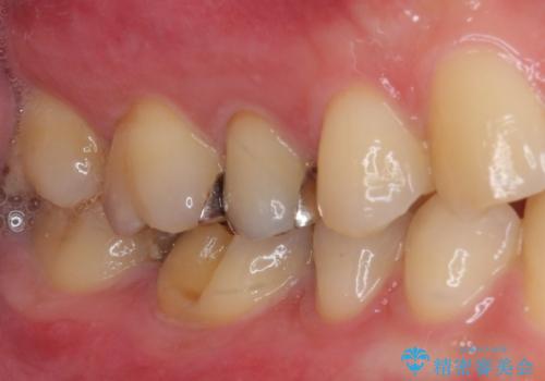 気がついたら歯が欠けていた 奥歯のセラミック補綴の治療前