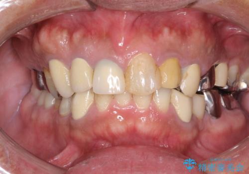 治療途中にステインをPMTCで除去の治療前