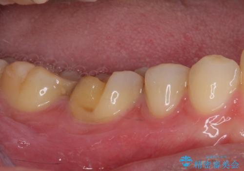 気がついたら歯が欠けていた 奥歯のセラミック補綴の治療前