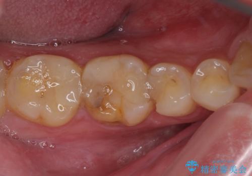 気がついたら歯が欠けていた 奥歯のセラミック補綴の治療前