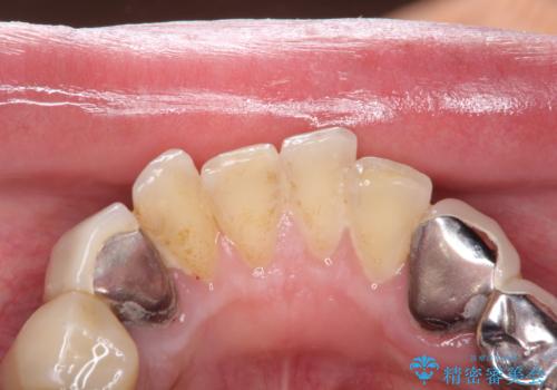 治療途中にステインをPMTCで除去の治療前