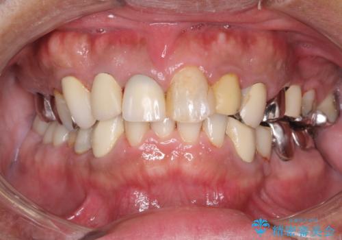 治療途中にステインをPMTCで除去の治療後