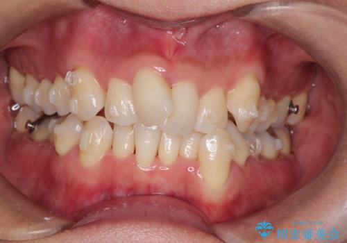 重度のガタガタのインビザラインによる非抜歯矯正の治療中