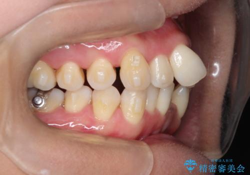 重度のガタガタのインビザラインによる非抜歯矯正の治療中