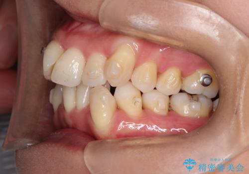 重度のガタガタのインビザラインによる非抜歯矯正の治療中