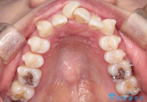重度のガタガタのインビザラインによる非抜歯矯正の治療中