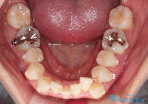 重度のガタガタのインビザラインによる非抜歯矯正の治療中