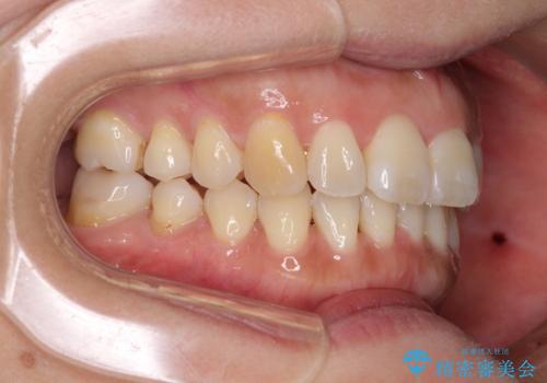 軽度な歯列不正　インビザライン・ライトによる矯正治療の治療中