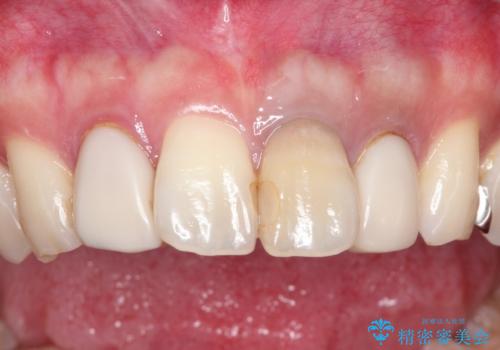 歯並びを含めて前歯をきれいにしたい インビザラインとセラミック治療の治療前