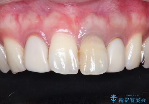 歯並びを含めて前歯をきれいにしたい インビザラインとセラミック治療の治療前