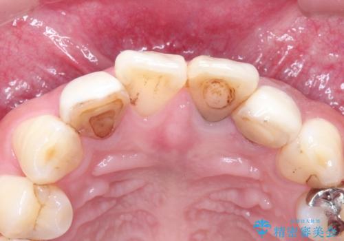 歯並びを含めて前歯をきれいにしたい インビザラインとセラミック治療の治療前