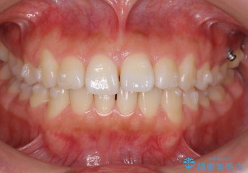 出っ歯 インビザラインで歯を抜かない治療の治療中