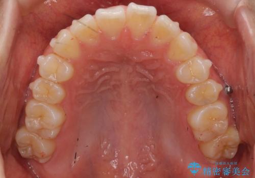 出っ歯 インビザラインで歯を抜かない治療の治療中