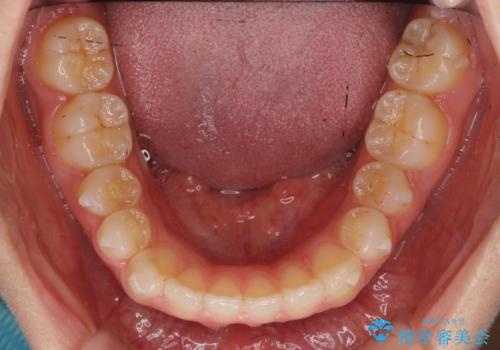 出っ歯 インビザラインで歯を抜かない治療の治療中