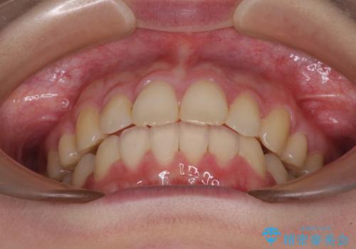 費用を抑えた抜歯矯正　口元の突出感の改善の治療後