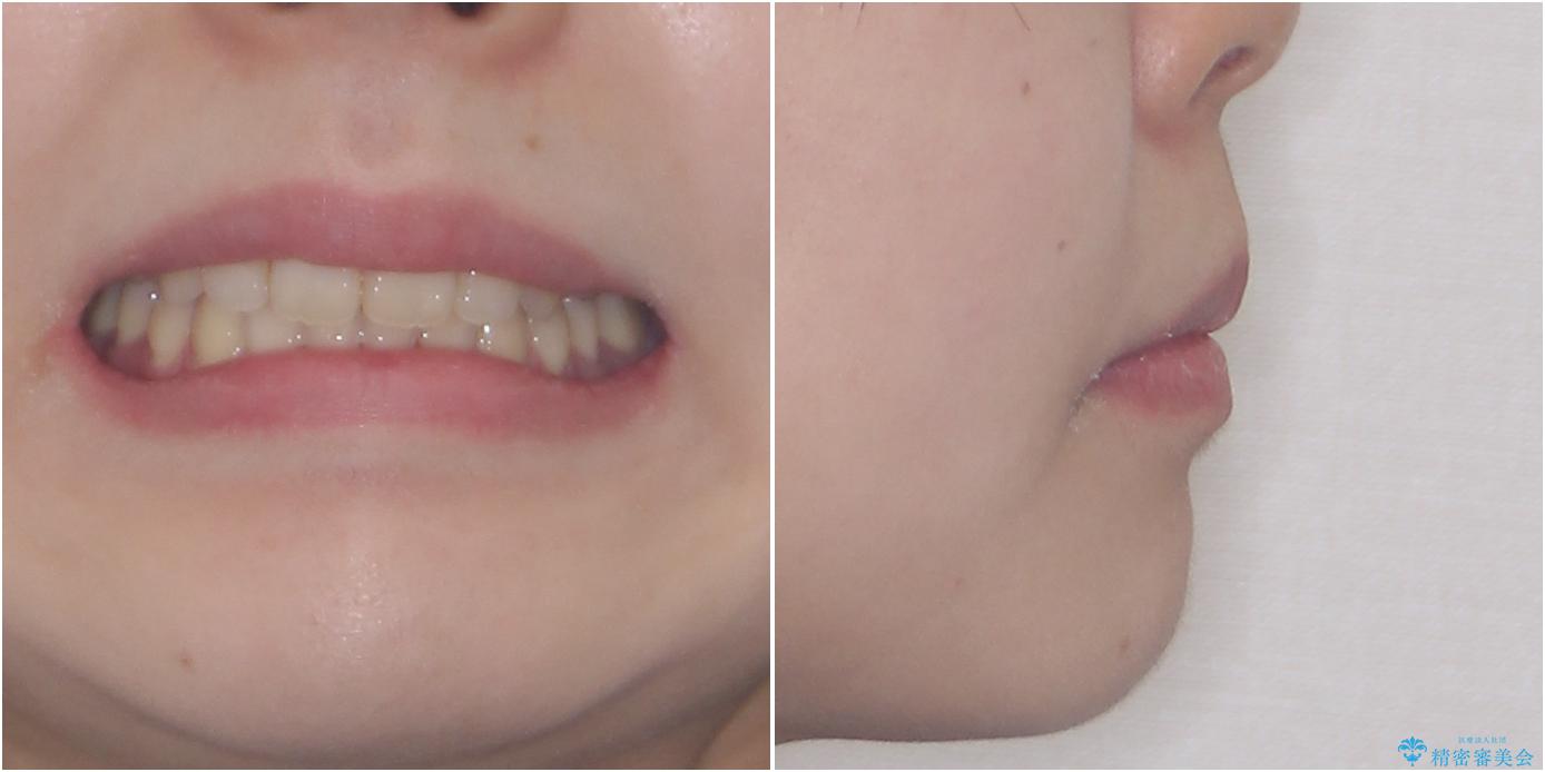 費用を抑えた抜歯矯正　口元の突出感の改善の治療後（顔貌）