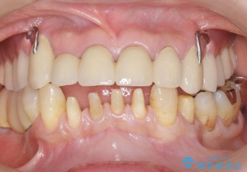 前歯がかけた、ぐらぐらする 60代女性の治療中