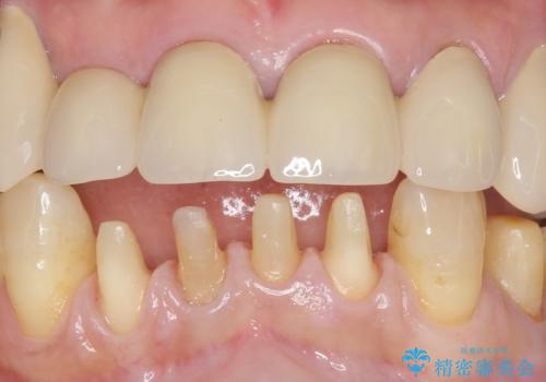 前歯がかけた、ぐらぐらする 60代女性の治療中