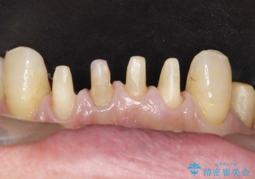 前歯がかけた、ぐらぐらする 60代女性の治療中