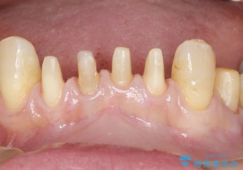 前歯がかけた、ぐらぐらする 60代女性の治療中