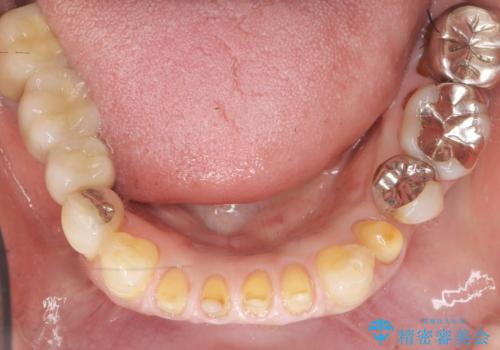 前歯がかけた、ぐらぐらする 60代女性の治療中